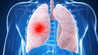Zatürre Ölümcül Seyredebilir! Kimler Risk Grubunda ve Nasıl Korunmalı?