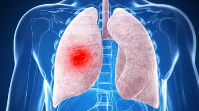 Zatürre Ölümcül Seyredebilir! Kimler Risk Grubunda ve Nasıl Korunmalı?