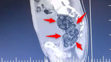 Erzincan’da Film Gibi Operasyon: Mideden Metamfetamin Çıktı!