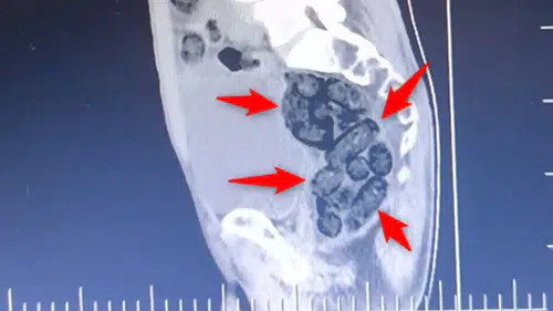 Erzincan’da Film Gibi Operasyon: Mideden Metamfetamin Çıktı!