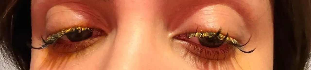 Güzellik merkezindeki işlem genç kadını kâbusa sürükledi! Gözlerinden oluyordu 2