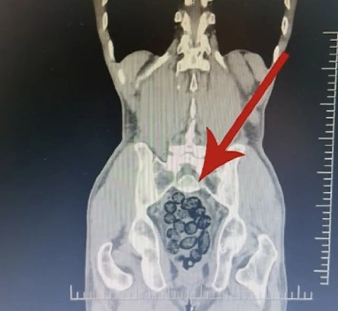 Yolcunun midesinden 64 parça uyuşturucu çıktı! Görenler gözlerine inanamadı 1