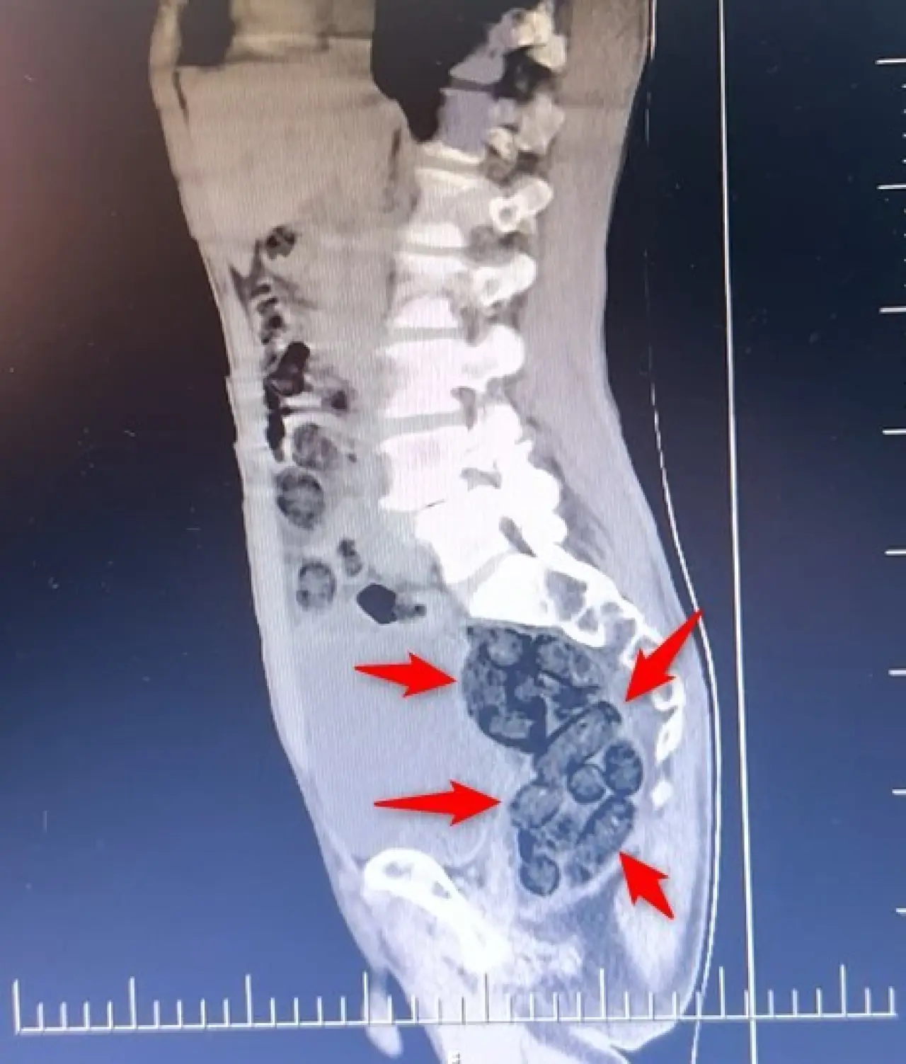Yolcunun midesinden 64 parça uyuşturucu çıktı! Görenler gözlerine inanamadı 5